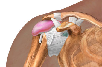 Bursitis